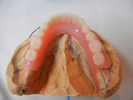 旧義歯と比較