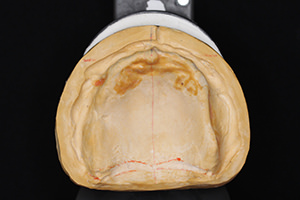 総義歯における、ポストダムをつける意味、そして位置や形態、厚みについて教えてください