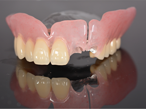 最近、ノンクラスプデンチャーや金具の見えない入れ歯などが流行っていますが、そのような義歯をどう思われますか？