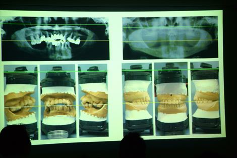 総義歯の基礎と臨床