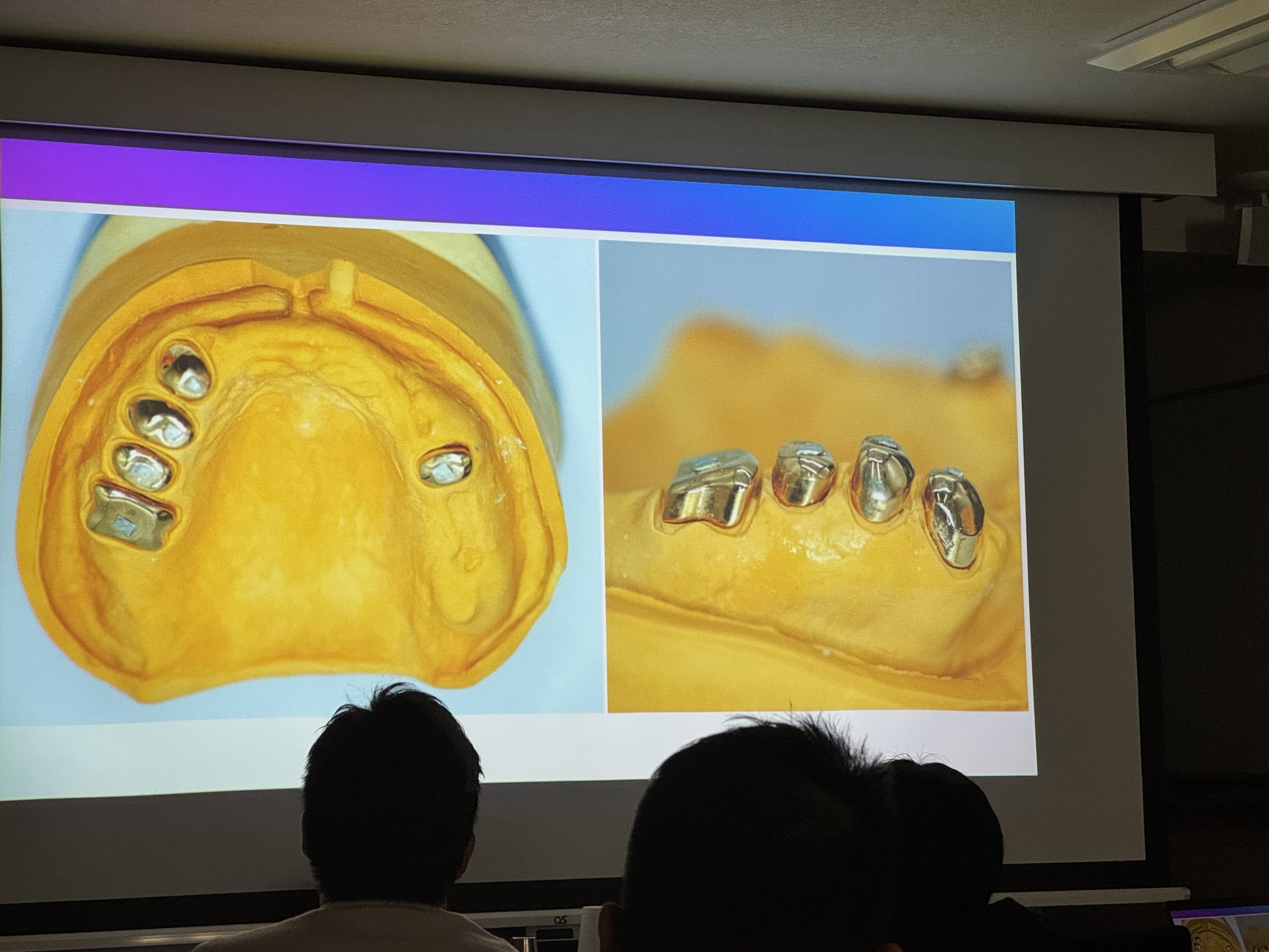 ’25 2/8,9(土,日)『パーシャルデンチャー・テレスコープシステム理論と実習コースセミナー』開催されました〜その3〜